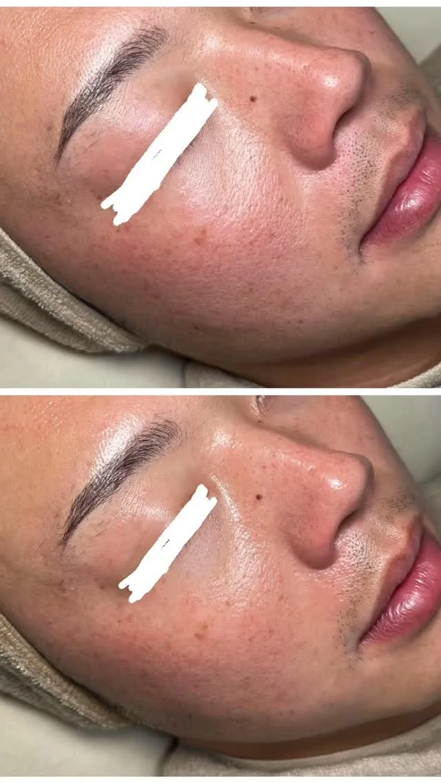 30代男性白玉肌ピーリング1回の効果！